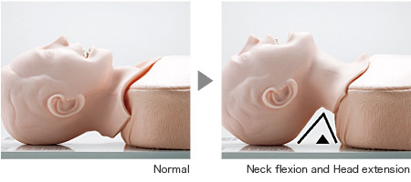 Neck flexion and Head extension